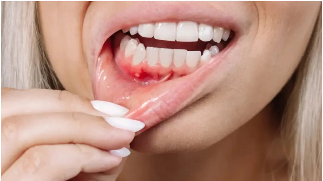 Health Tips: വായ്പ്പുണ്ണ് മാറാന് വീട്ടില് പരീക്ഷിക്കേണ്ട പത്ത് ടിപ്സ് Health Tips: വായ്പ്പുണ്ണ് മാറാന് വീട്ടില് പരീക്ഷിക്കേണ്ട പത്ത് ടിപ്സ്