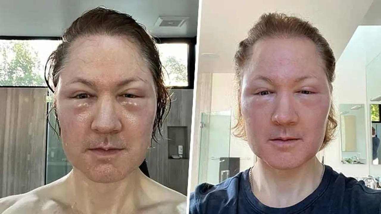 Biohacker Bryan Johnson's 'age defying' treatment goes horribly wrong; shocking selfie shows extreme swelling