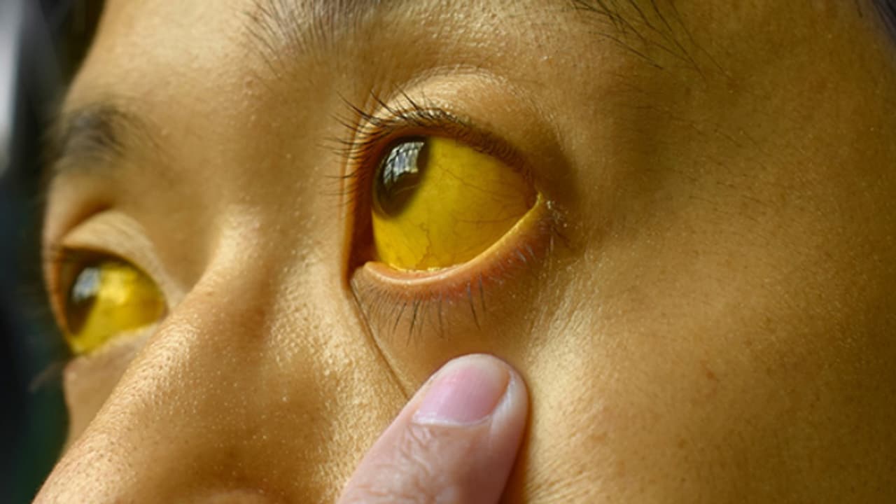 മഞ്ഞപ്പിത്തം പകരുന്നതെങ്ങനെ ? പ്രതിരോധമാർ​ഗങ്ങൾ എന്തൊക്കെ?