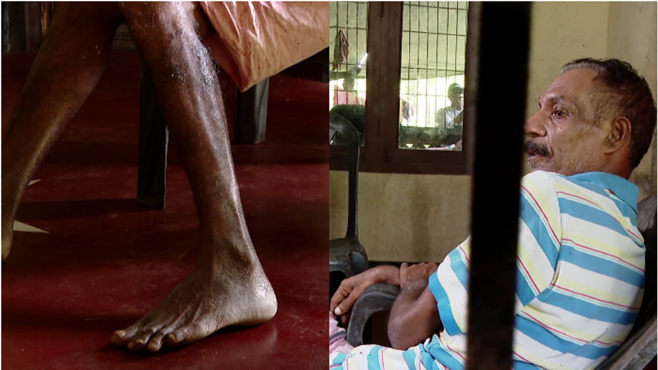 പഴുപ്പ് വന്ന് ശരീരം പൊട്ടിയൊലിക്കുന്നു; പ്രവാസം വഴിമുട്ടി, ഇപ്പോൾ നാട്ടിലും ജോലിയില്ല; രാമചന്ദ്രന് സഹായം വേണം പഴുപ്പ് വന്ന് ശരീരം പൊട്ടിയൊലിക്കുന്നു; പ്രവാസം വഴിമുട്ടി, ഇപ്പോൾ നാട്ടിലും ജോലിയില്ല; രാമചന്ദ്രന് സഹായം വേണം