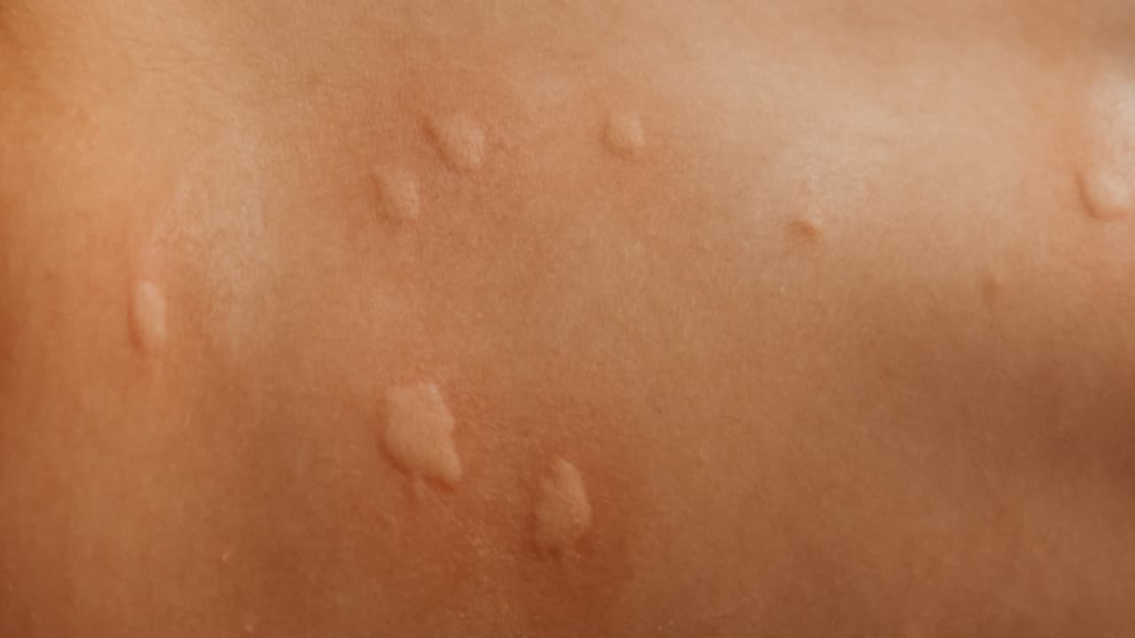 ആലപ്പുഴയിലെ സ്കൂളിൽ 27 വിദ്യാര്ത്ഥികൾക്ക് കൂട്ടത്തോടെ ചൊറിച്ചിലും ദേഹാസ്വാസ്ഥ്യവും; സ്കൂളിന് അവധി നൽകി ആലപ്പുഴയിലെ സ്കൂളിൽ 27 വിദ്യാര്ത്ഥികൾക്ക് കൂട്ടത്തോടെ ചൊറിച്ചിലും ദേഹാസ്വാസ്ഥ്യവും; സ്കൂളിന് അവധി നൽകി