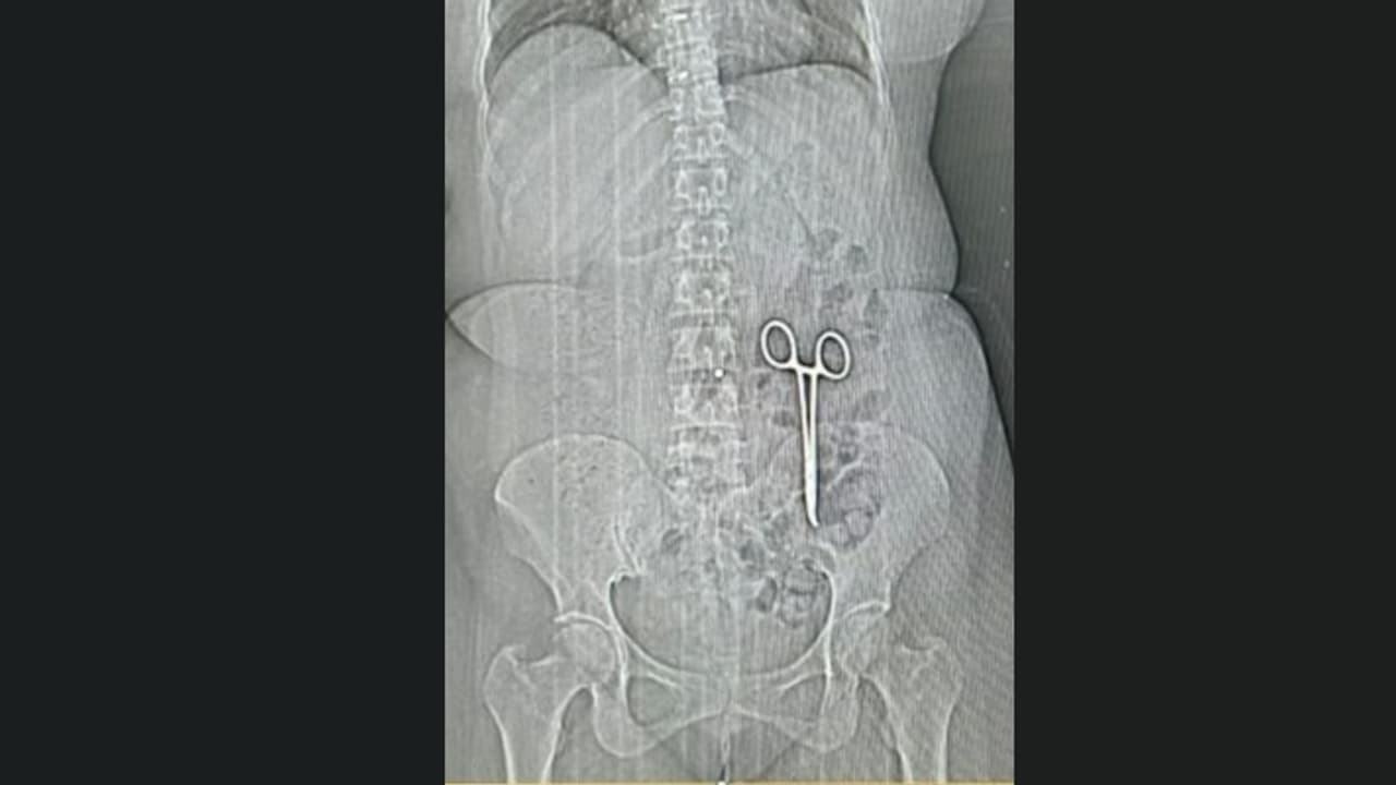 രണ്ട് വർഷമായി വിട്ടുമാറാത്ത വയറുവേദന, മരുന്നുകളൊന്നും ഫലിച്ചില്ല; സിടി സ്കാൻ ചെയ്തപ്പോൾ ഞെട്ടൽ, കണ്ടത് കത്രിക രണ്ട് വർഷമായി വിട്ടുമാറാത്ത വയറുവേദന, മരുന്നുകളൊന്നും ഫലിച്ചില്ല; സിടി സ്കാൻ ചെയ്തപ്പോൾ ഞെട്ടൽ, കണ്ടത് കത്രിക