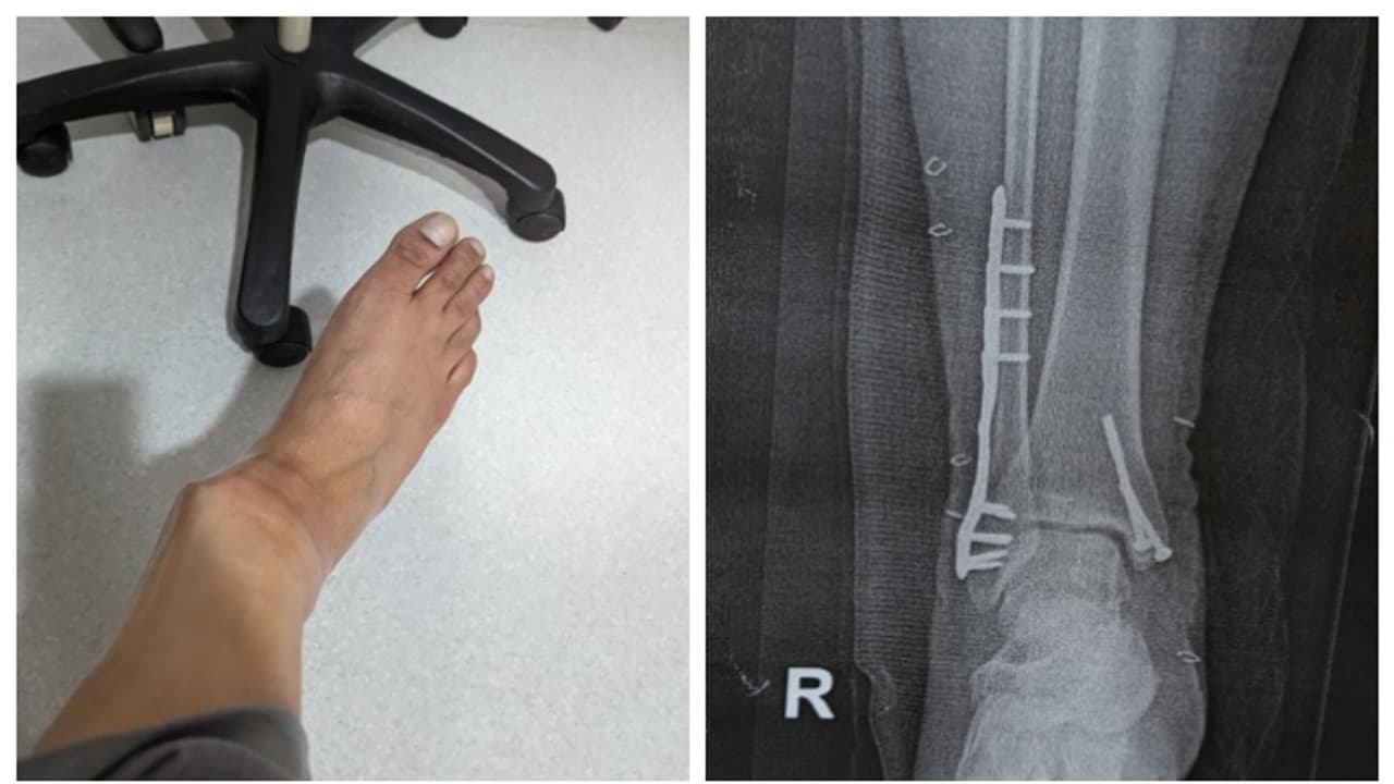 ഇന്‍ഡിഗോയുടെ റാമ്പ് ഉപയോഗിക്കവെ തകര്‍ന്ന് പോയ തന്‍റെ കാലിന്‍റെ അനുഭവം പങ്കുവച്ച് യുവാവ്; കുറിപ്പ് വൈറൽ 