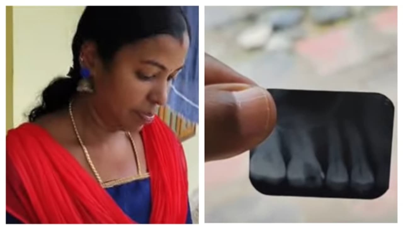 റൂട്ട് കനാൽ ചെയ്ത പല്ലിൽ സൂചി ഒടിഞ്ഞിരിക്കുന്നു, നെടുമങ്ങാട് ജില്ല ആശുപത്രിയിൽ ചികിത്സ പിഴവെന്ന് പരാതി