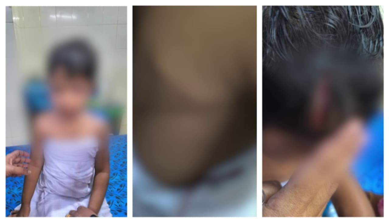 കൊല്ലത്ത് മുത്തച്ഛനൊപ്പം നടന്നു പോയ 3 വയസുകാരിയെ തെരുവുനായ ആക്രമിച്ചു; തലക്കും കൈകൾക്കും പരിക്ക് കൊല്ലത്ത് മുത്തച്ഛനൊപ്പം നടന്നു പോയ 3 വയസുകാരിയെ തെരുവുനായ ആക്രമിച്ചു; തലക്കും കൈകൾക്കും പരിക്ക്