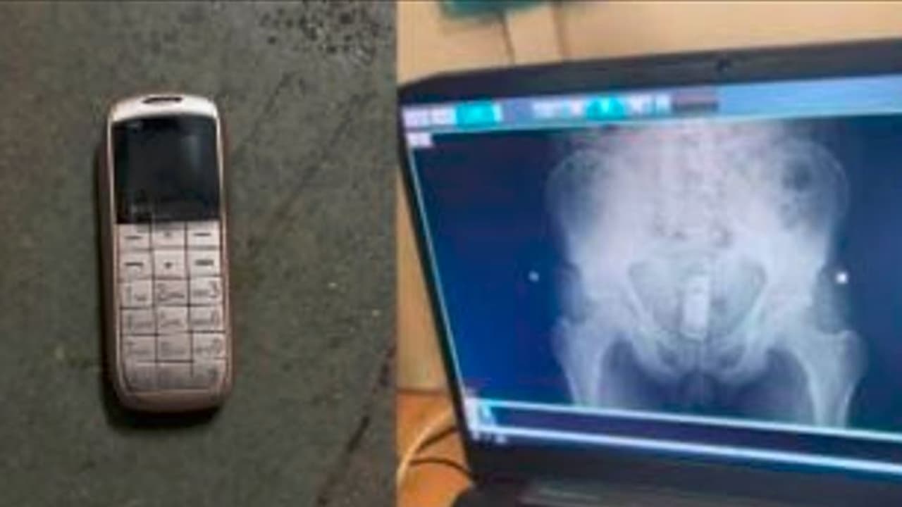 ಇಡಬಾರದ ಜಾಗದಲ್ಲಿ ಮೊಬೈಲ್ ಫೋನ್ ಅಡಗಿಸಿಟ್ಟ ಕೈದಿ: ಎಕ್ಸ್‌ರೇ ಮಾಡಿಸಿದ ಪೊಲೀಸರಿಗೆ ಶಾಕ್