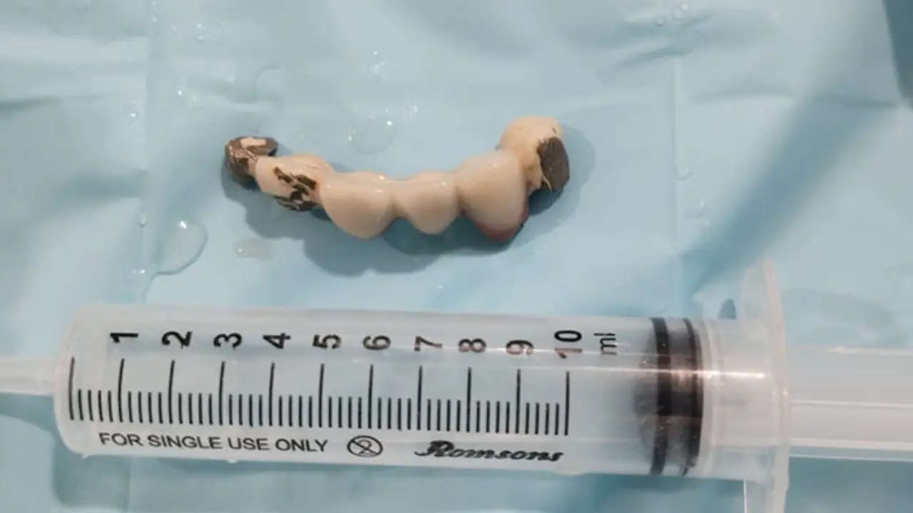 Visakhapatnam: Man swallows Dentures while sleeping; Doctors extract them from Lung Visakhapatnam: Man swallows Dentures while sleeping; Doctors extract them from Lung