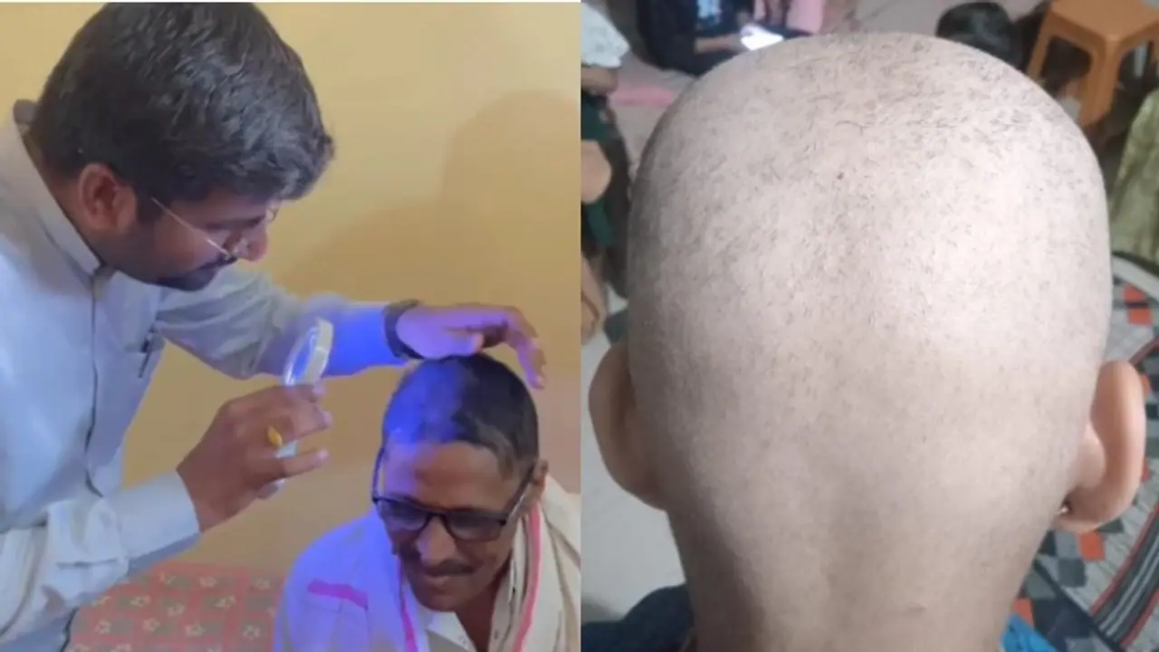 ഒന്നു തൊട്ടാൽ മതി, മുടിയെല്ലാം കൊഴിഞ്ഞുവീഴുന്നു; നിരവധിപ്പേർക്ക് തലയിൽ ഒരു മുടി പോലുമില്ലാതായത് ഒരാഴ്ച കൊണ്ട്