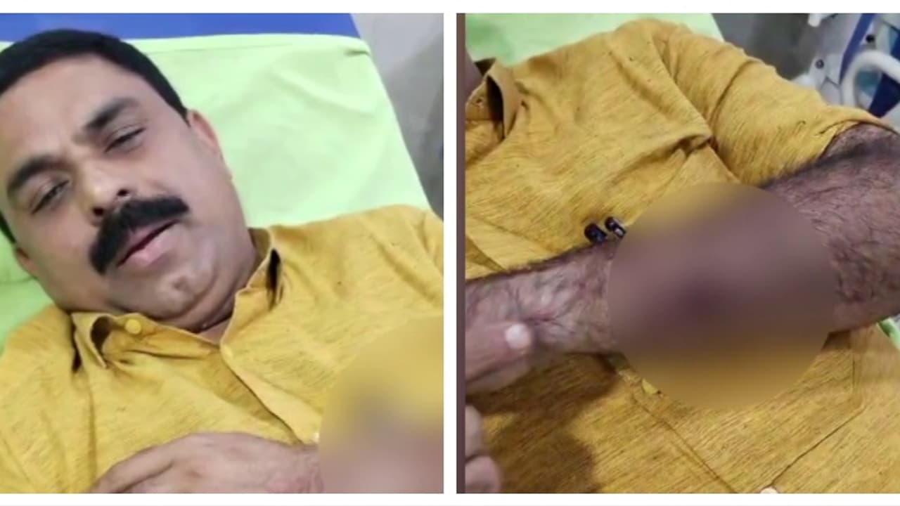 അവിശ്വാസ പ്രമേയത്തെ അനുകൂലിച്ച് വോട്ട് ചെയ്തു; പനമരത്ത് വാർഡ് മെമ്പർക്ക് നേരെ ആക്രമണം, കൈക്ക് ഗുരുതരപരിക്ക് അവിശ്വാസ പ്രമേയത്തെ അനുകൂലിച്ച് വോട്ട് ചെയ്തു; പനമരത്ത് വാർഡ് മെമ്പർക്ക് നേരെ ആക്രമണം, കൈക്ക് ഗുരുതരപരിക്ക്