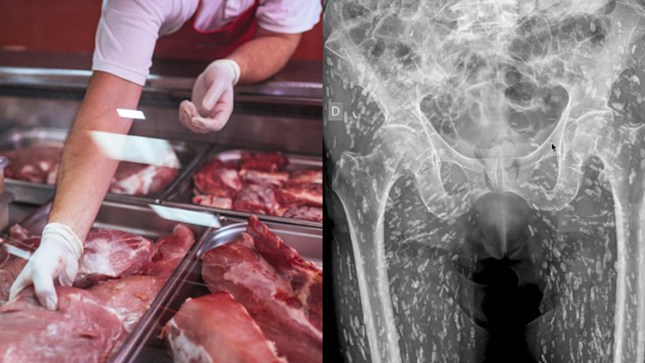 അസഹ്യമായ ഇടുപ്പ് വേദന, വർഷങ്ങളായി ചികിത്സ, ഒടുവിൽ കണ്ടെത്തിയത് ഭക്ഷണത്തിലെ അശ്രദ്ധ, ഗുരുതരാവസ്ഥയിൽ യുവാവ് 