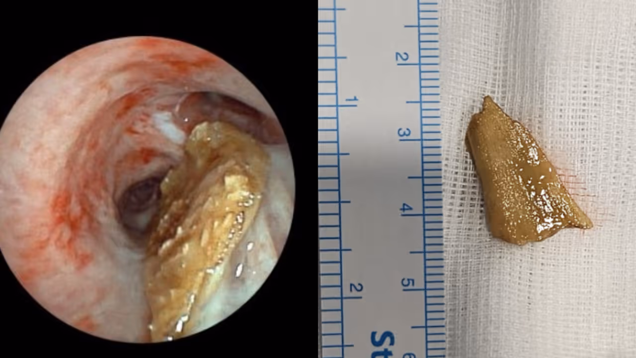 ബീഫ് കറി കൂട്ടി അത്താഴം കഴിച്ചതിന് പിന്നാലെ കൊച്ചിയിൽ 84കാരി അവശനിലയിൽ, ശ്വാസകോശത്തിൽ നിന്ന് കിട്ടിയത് എല്ല് 