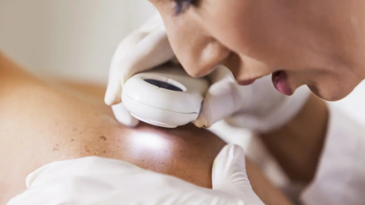 skin cancer