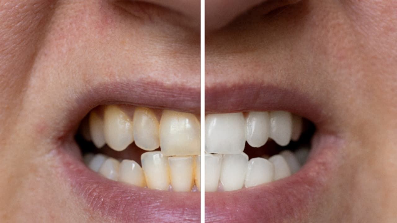 കൊവിഡിന് ശേഷം വന്ന മാറ്റം നിസാരമായി കാണരുത്, നന്നായി ചിരിക്കാൻ, ഉള്ള് തുറന്ന് സന്തോഷിക്കാൻ പല്ല് സൂക്ഷിക്കണം കൊവിഡിന് ശേഷം വന്ന മാറ്റം നിസാരമായി കാണരുത്, നന്നായി ചിരിക്കാൻ, ഉള്ള് തുറന്ന് സന്തോഷിക്കാൻ പല്ല് സൂക്ഷിക്കണം