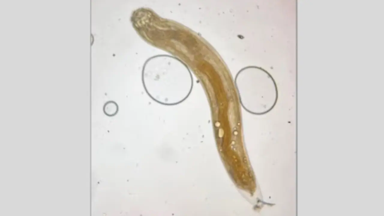 കാഴ്ച മങ്ങുന്നു, പല മരുന്ന് കഴിച്ചിട്ടും ഫലമില്ല; ഒടുവിൽ 35കാരന്റെ കണ്ണിൽ നിന്ന് പുറത്തെടുത്തത് ജീവനുള്ള വിര കാഴ്ച മങ്ങുന്നു, പല മരുന്ന് കഴിച്ചിട്ടും ഫലമില്ല; ഒടുവിൽ 35കാരന്റെ കണ്ണിൽ നിന്ന് പുറത്തെടുത്തത് ജീവനുള്ള വിര