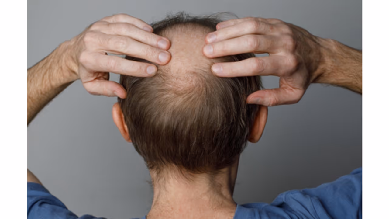 Understanding the Causes of Hair Loss: Expert Insights and Prevention Tips