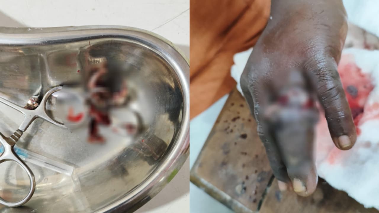 കാലങ്ങളായി ഊരാതിരുന്ന മോതിരങ്ങൾ കുടുങ്ങി നീര് വച്ചു, ബുദ്ധിമുട്ടെന്ന് ഡോക്ടർമാർ; ഒടുവിൽ രക്ഷകരായി ഫയർഫോഴ്സ് കാലങ്ങളായി ഊരാതിരുന്ന മോതിരങ്ങൾ കുടുങ്ങി നീര് വച്ചു, ബുദ്ധിമുട്ടെന്ന് ഡോക്ടർമാർ; ഒടുവിൽ രക്ഷകരായി ഫയർഫോഴ്സ്