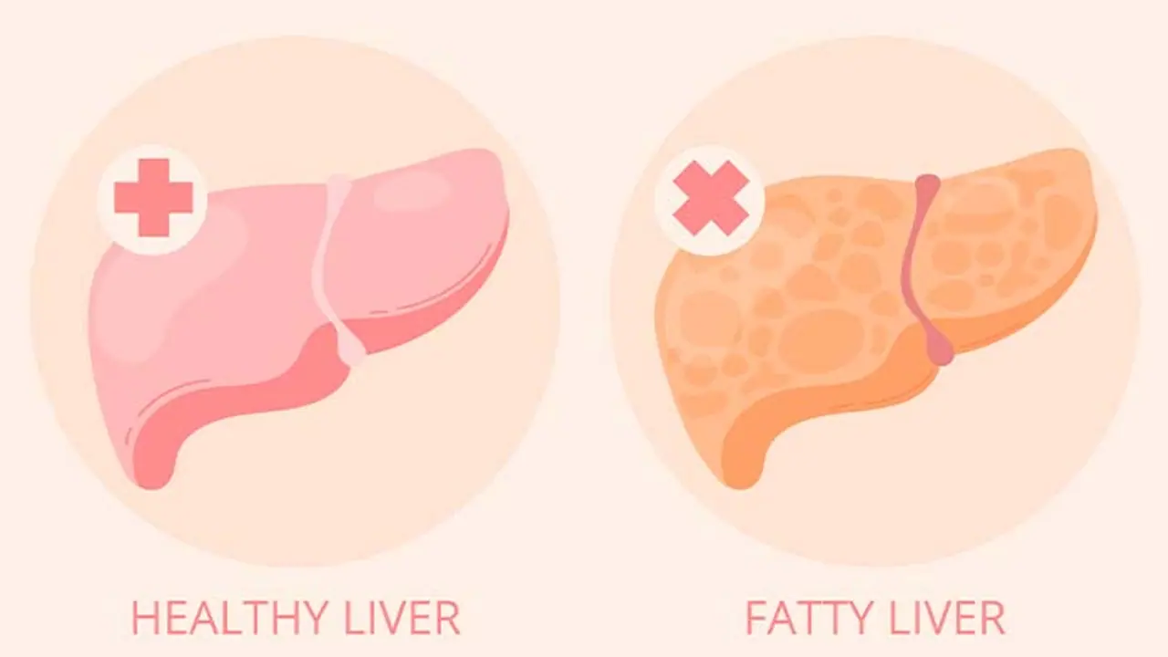 Increasing risk of fatty liver: symptoms, preventative care, diet, lifestyle
