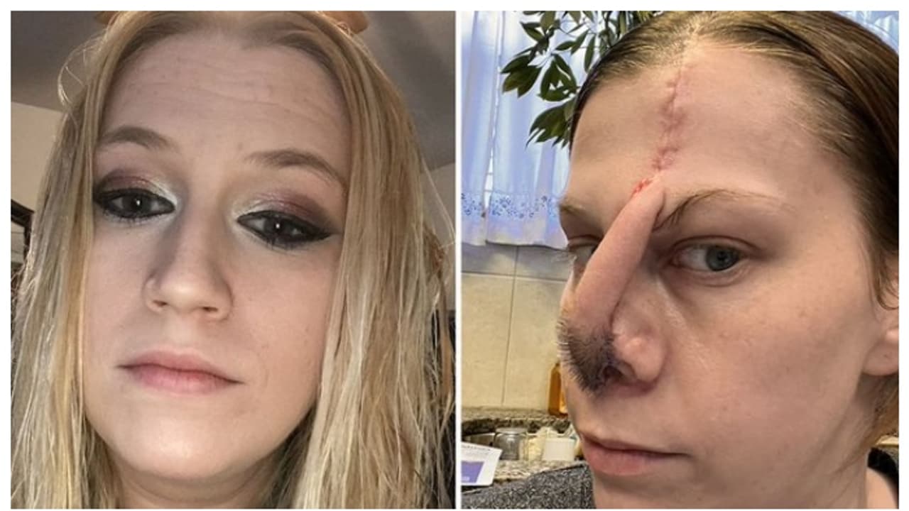 19 മാസത്തിനുള്ളിൽ 70 ലക്ഷം രൂപയുടെ കൊക്കെയ്ന്‍ ഉപയോഗം, ഒടുവില്‍ അവശേഷിച്ചത് മൂക്കിന്‍റെ സ്ഥാനത്ത് ഒരു ദ്വാരം