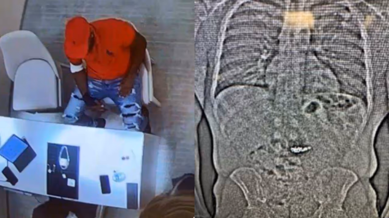 കോടികൾ വിലവരുന്ന വജ്ര കമ്മലുകൾ വിഴുങ്ങി 32കാരൻ, തൊണ്ടിമുതൽ തിരിച്ചെടുക്കാനാവാതെ പൊലീസ്