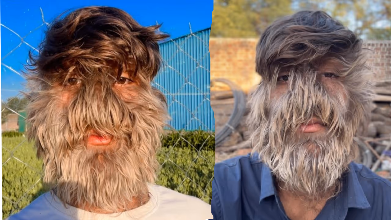 ಮುಖದ ತುಂಬೆಲ್ಲ ಕೂದಲು; ಕಾಯಿಲೆಯಿಂದಲೇ ವಿಶ್ವದಾಖಲೆ ಬರೆದ 18 ವರ್ಷದ ಲಲಿತ್ ಪಾಟೀದಾರ್ ಮುಖದ ತುಂಬೆಲ್ಲ ಕೂದಲು; ಕಾಯಿಲೆಯಿಂದಲೇ ವಿಶ್ವದಾಖಲೆ ಬರೆದ 18 ವರ್ಷದ ಲಲಿತ್ ಪಾಟೀದಾರ್