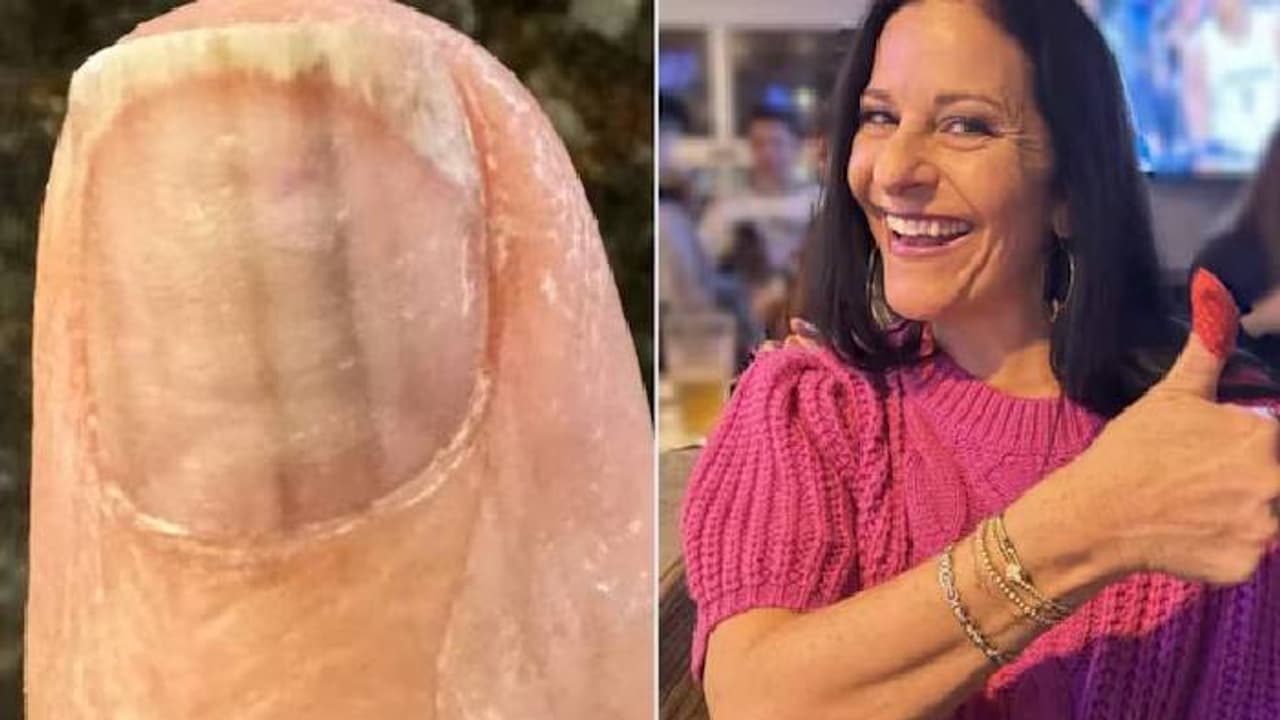 നഖത്തിന് മുകളിൽ രണ്ട് കറുത്ത പാടുകൾ, ആദ്യം ഗൗനിച്ചില്ല, ഒരുമാസം കഴിഞ്ഞിട്ടും പോയില്ല, ടെസ്റ്റ്, കണ്ടെത്തിയത് നഖത്തിന് മുകളിൽ രണ്ട് കറുത്ത പാടുകൾ, ആദ്യം ഗൗനിച്ചില്ല, ഒരുമാസം കഴിഞ്ഞിട്ടും പോയില്ല, ടെസ്റ്റ്, കണ്ടെത്തിയത്