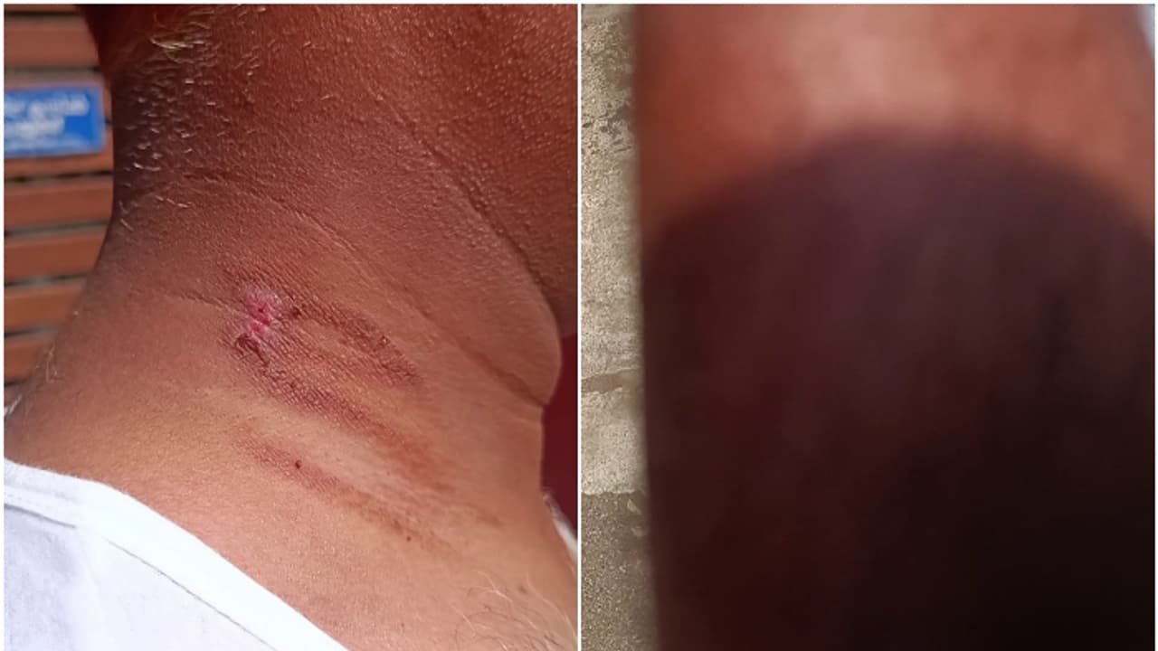  സംസ്ഥാനത്ത് ചൂട് കൂടുന്നു, 3 ജില്ലകളിലായി 3 പേർക്ക് സൂര്യാതപമേറ്റു