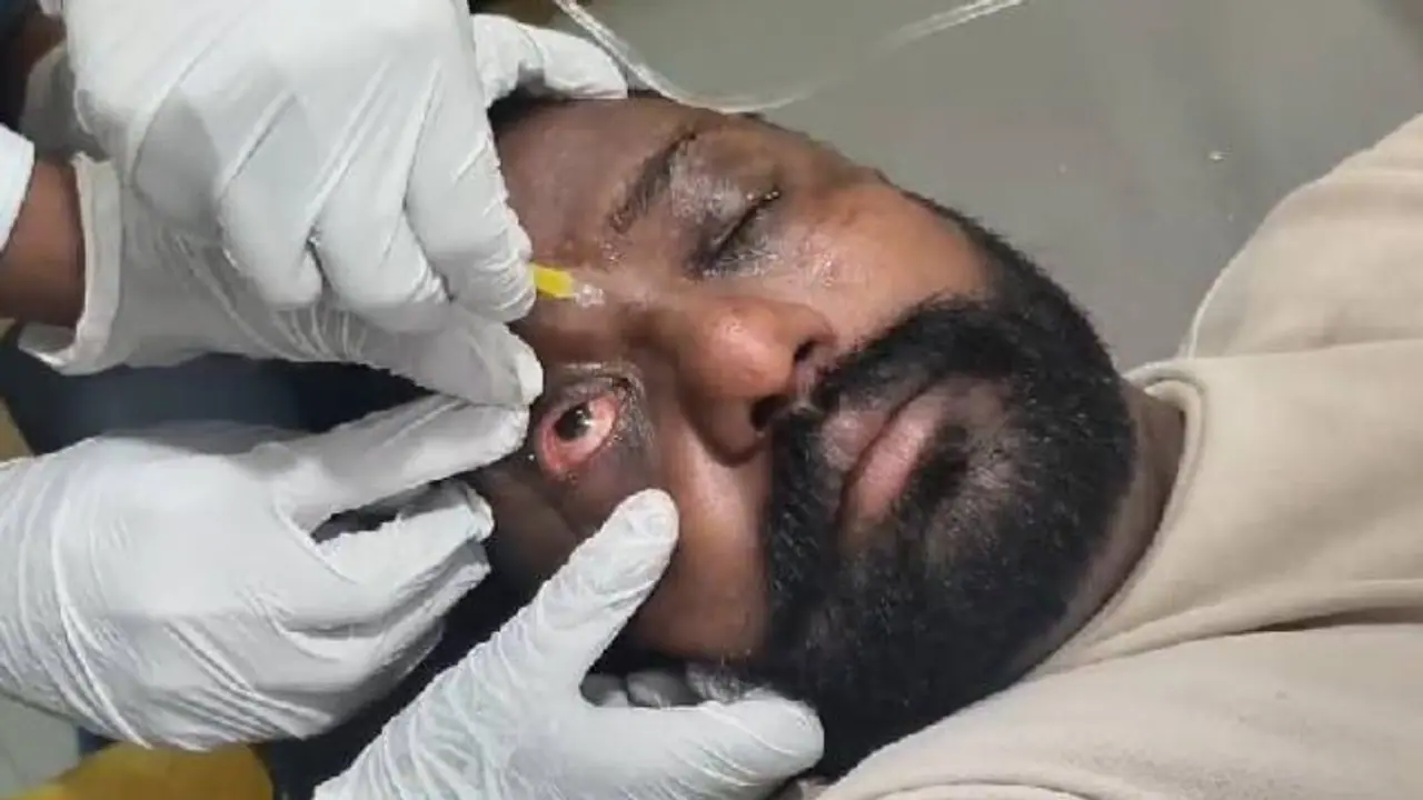  ಬೋಳು ತಲೆಗೆ ಕೂದಲು ಬೆಳೆಸೋಕೆ ಹೋಗಿ 20 ಜನರಿಗೆ ಕಣ್ಣಿನ ಸೋಂಕು!