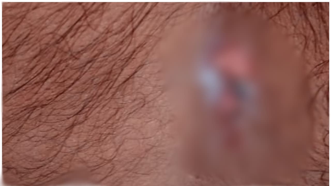 പപ്പടത്തിന്റെ ആകൃതിയിൽ പൊള്ളൽ, തൊലി അടർന്നു; ചെർപ്പുളശ്ശേരിയിൽ ഓട്ടോഡ്രൈവർക്ക് സൂര്യാതപമേറ്റു പപ്പടത്തിന്റെ ആകൃതിയിൽ പൊള്ളൽ, തൊലി അടർന്നു; ചെർപ്പുളശ്ശേരിയിൽ ഓട്ടോഡ്രൈവർക്ക് സൂര്യാതപമേറ്റു