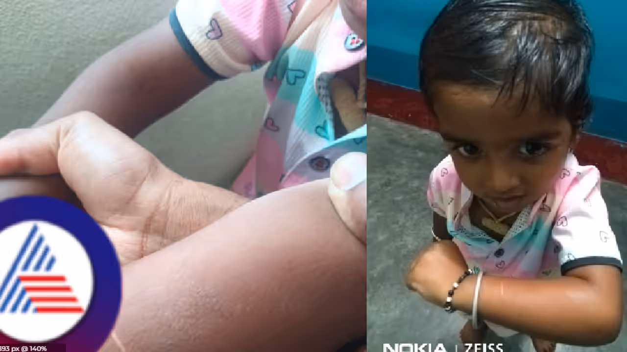 ಹಠ ಮಾಡ್ತಿದೆ ಅಂತಾ ಮಗು ಕೈಮೇಲೆ ಬರೆ, ಡೈಪರ್ ಗೆ ಖಾರದ ಪುಡಿ ಹಾಕಿ ಅಂಗನವಾಡಿ ಸಹಾಯಕಿ ವಿಕೃತಿ!