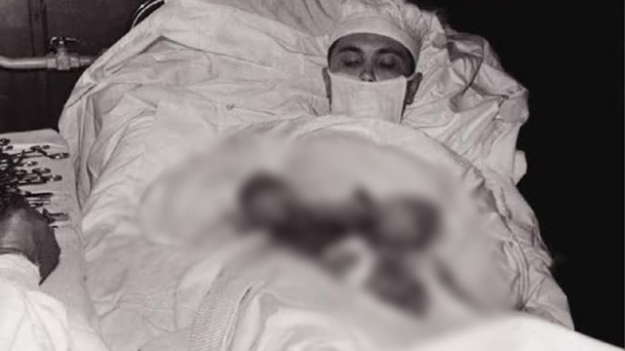 'ഒരു കണ്ണാടിയിലെ പ്രതിബിംബം നോക്കി രാത്രിയിൽ എങ്ങനെ അപ്പൻഡിക്സിൻ്റെ ബേസിൽ തയ്യലിട്ടു'; വൈറലായി കുറിപ്പ് 