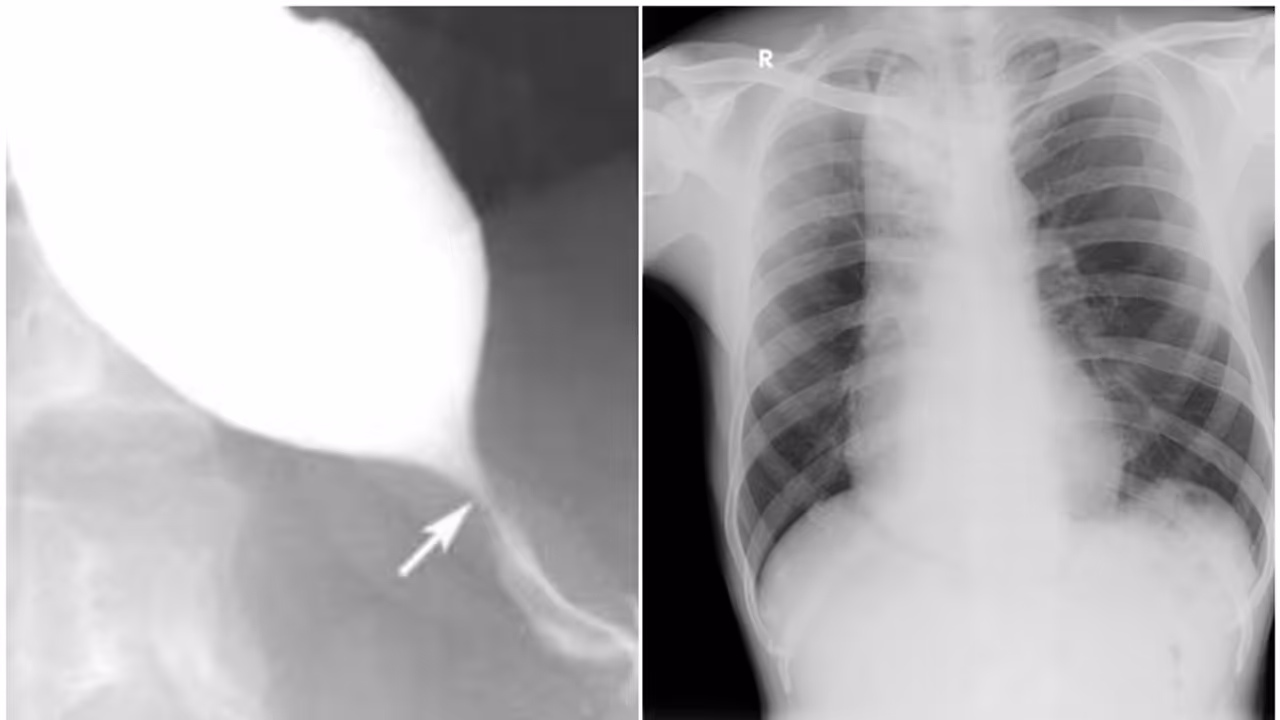 അക്കാലാസിയ കാര്‍ഡിയ, ഭക്ഷണം പോലും കഴിക്കാന്‍ കഴിയാത്ത അവസ്ഥ; ചികിത്സിച്ച് ഭേദമാക്കി കോഴിക്കോട് മെഡിക്കൽ കോളേജ്