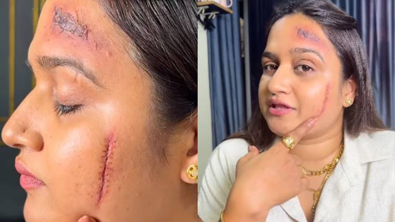 നിമിഷങ്ങൾക്കുള്ളിൽ നെറ്റിയിലും കവിളത്തും മുറിവേറ്റതിന്റെ പാടുകൾ, സിക്ക് ലീവ് കിട്ടാൻ പറ്റിയ മേക്കപ്പ്, വിമർശനം