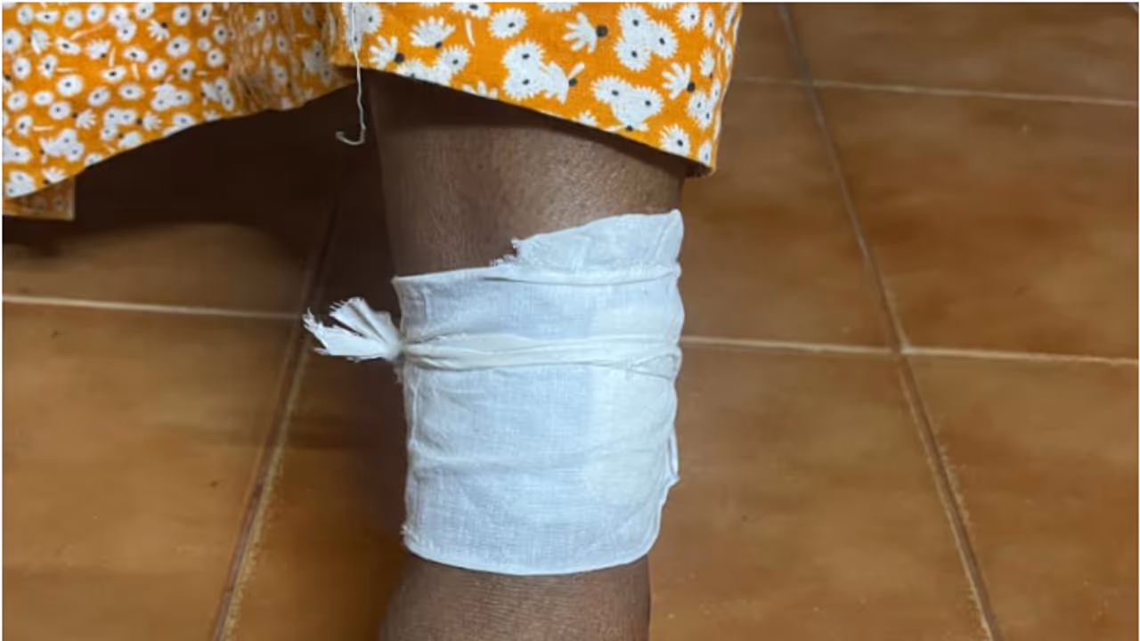 തെരുവുനായയെ കണ്ട് വിരണ്ടോടി, ഒട്ടത്തിനിടെ വീണവര്‍ക്ക് പരിക്ക്; കൂട്ടത്തില്‍ വീട്ടമ്മയ്ക്ക് കടിയേറ്റു