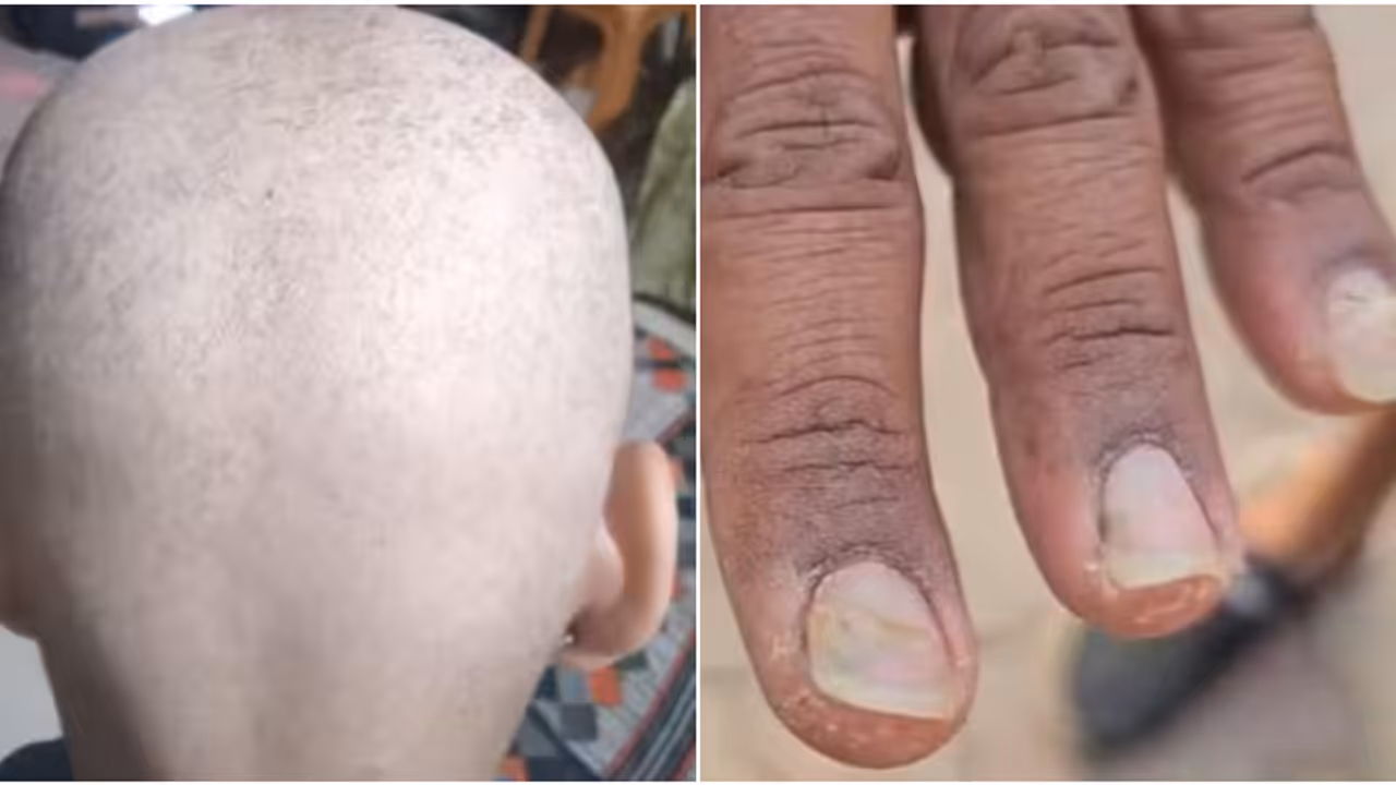 ഒരാഴ്ച കൊണ്ട് 279 പേർക്ക് തലയിൽ ഒരു മുടി പോലുമില്ലാതായ ജില്ലയിൽ വീണ്ടും ആശങ്ക; നഖങ്ങൾ തനിയെ കൊഴിയുന്നു