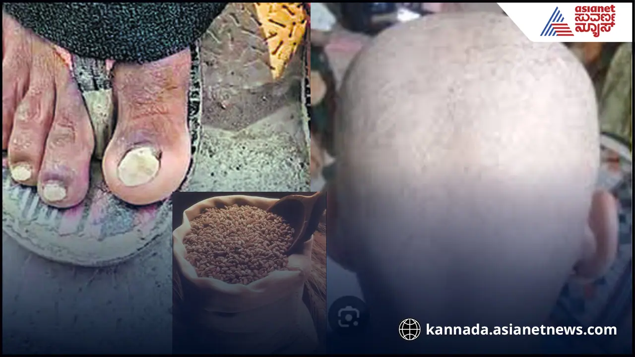 ಸರ್ಕಾರದ ಗೋಧಿ ಎಫೆಕ್ಟ್? ಹಲವು ಊರುಗಳಲ್ಲಿ ತಲೆಬೋಳು, ಕಳಚುತ್ತಿವೆ ಉಗುರು! ಎಲ್ಲೆಡೆ ಆತಂಕ ಸರ್ಕಾರದ ಗೋಧಿ ಎಫೆಕ್ಟ್? ಹಲವು ಊರುಗಳಲ್ಲಿ ತಲೆಬೋಳು, ಕಳಚುತ್ತಿವೆ ಉಗುರು! ಎಲ್ಲೆಡೆ ಆತಂಕ