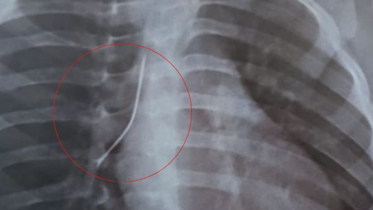 ഒരു വയസുള്ള കുട്ടിയ്ക്ക് ശ്വാസമെടുക്കാൻ കടുത്ത ബുദ്ധിമുട്ട്; ആശുപത്രിയിൽ എക്സ്റേ എടുത്തപ്പോൾ ശ്വാസനാളത്തിൽ പിൻ