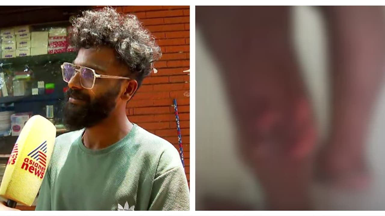 വാക്സിൻ എടുത്തിട്ടും പേവിഷബാധ, തലയ്ക്ക് കടിയേറ്റതാകാം കാരണമെന്ന് ഡോക്ടർമാർ; കുഞ്ഞ് ഗുരുതരാവസ്ഥയിലെന്ന് അച്ഛൻ