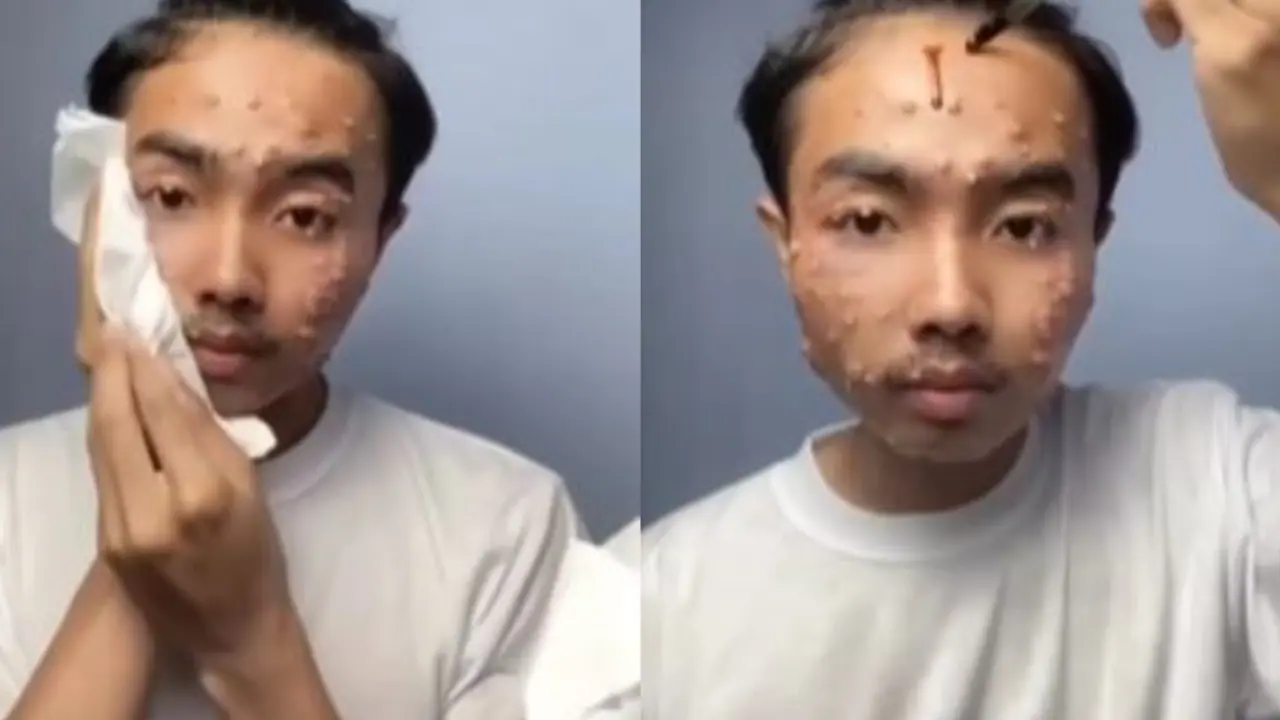 ಹಣ ಉಳಿಸಲು ಸೆಕೆಂಡ್ ಹ್ಯಾಂಡ್ ಬಟ್ಟೆ ಖರೀದಿಸ್ತೀರಾ? ಈ ಯುವಕನ ಚರ್ಮರೋಗ ಕೇಳಿದ್ರೆ ಶಾಕ್! ಹಣ ಉಳಿಸಲು ಸೆಕೆಂಡ್ ಹ್ಯಾಂಡ್ ಬಟ್ಟೆ ಖರೀದಿಸ್ತೀರಾ? ಈ ಯುವಕನ ಚರ್ಮರೋಗ ಕೇಳಿದ್ರೆ ಶಾಕ್!