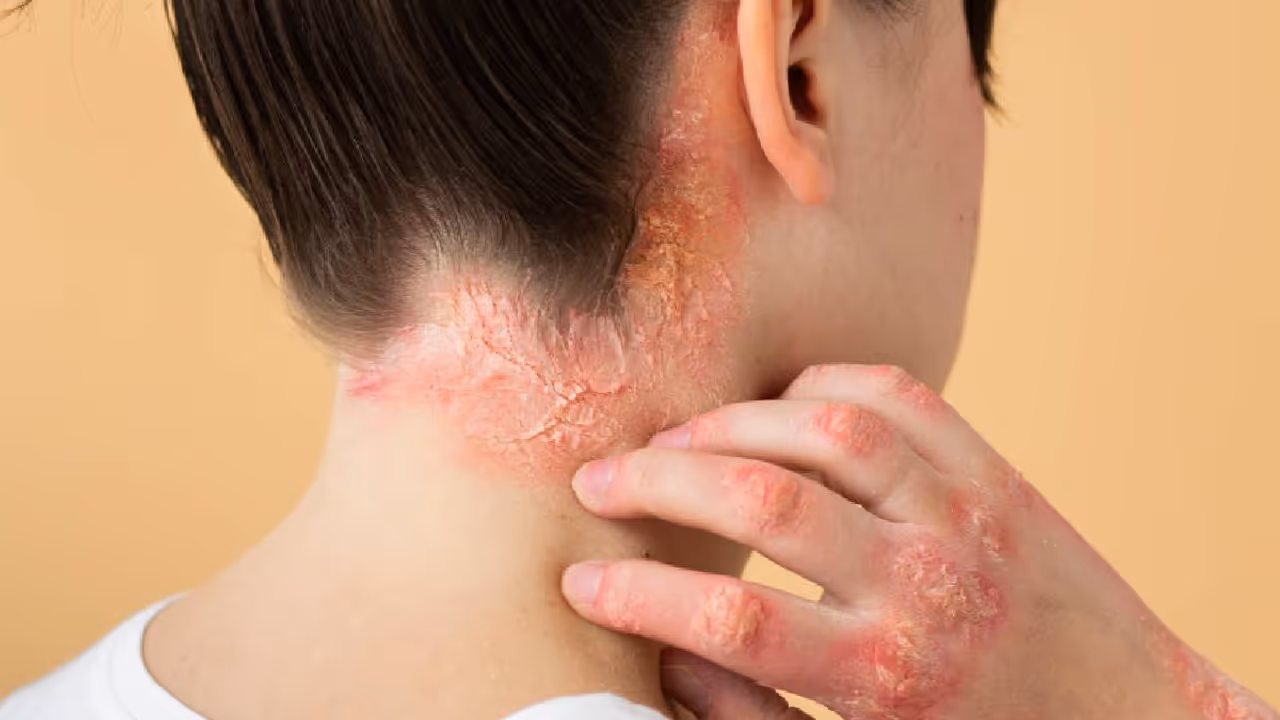 Lupus Day 2025 Symptoms and Causes