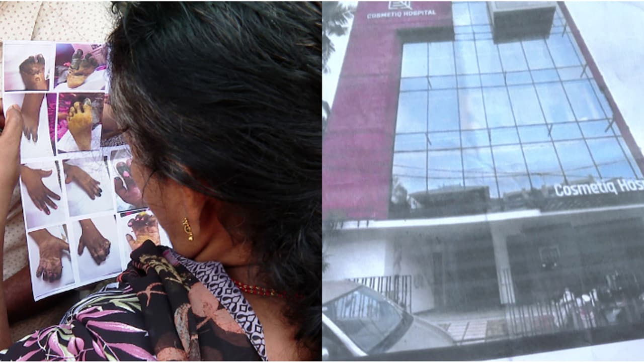 കൊഴുപ്പ് നീക്കൽ ശസ്ത്രക്രിയയിലെ പിഴവ്; ഉരുണ്ടുകളിച്ച് മെഡിക്കൽ ബോർഡ്,ചികിത്സാവീഴ്ച മറച്ചുവെച്ച് റിപ്പോർട്ട് കൊഴുപ്പ് നീക്കൽ ശസ്ത്രക്രിയയിലെ പിഴവ്; ഉരുണ്ടുകളിച്ച് മെഡിക്കൽ ബോർഡ്,ചികിത്സാവീഴ്ച മറച്ചുവെച്ച് റിപ്പോർട്ട്