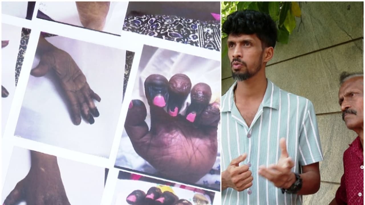 കൊഴുപ്പ് നീക്കൽ ശസ്ത്രക്രിയ; 'ക്ഷീണം പറഞ്ഞപ്പോൾ കാര്യമായി എടുത്തില്ല', നീതു വെന്റിലേറ്ററിൽ കഴിഞ്ഞത് 21 ദിവസം കൊഴുപ്പ് നീക്കൽ ശസ്ത്രക്രിയ; 'ക്ഷീണം പറഞ്ഞപ്പോൾ കാര്യമായി എടുത്തില്ല', നീതു വെന്റിലേറ്ററിൽ കഴിഞ്ഞത് 21 ദിവസം