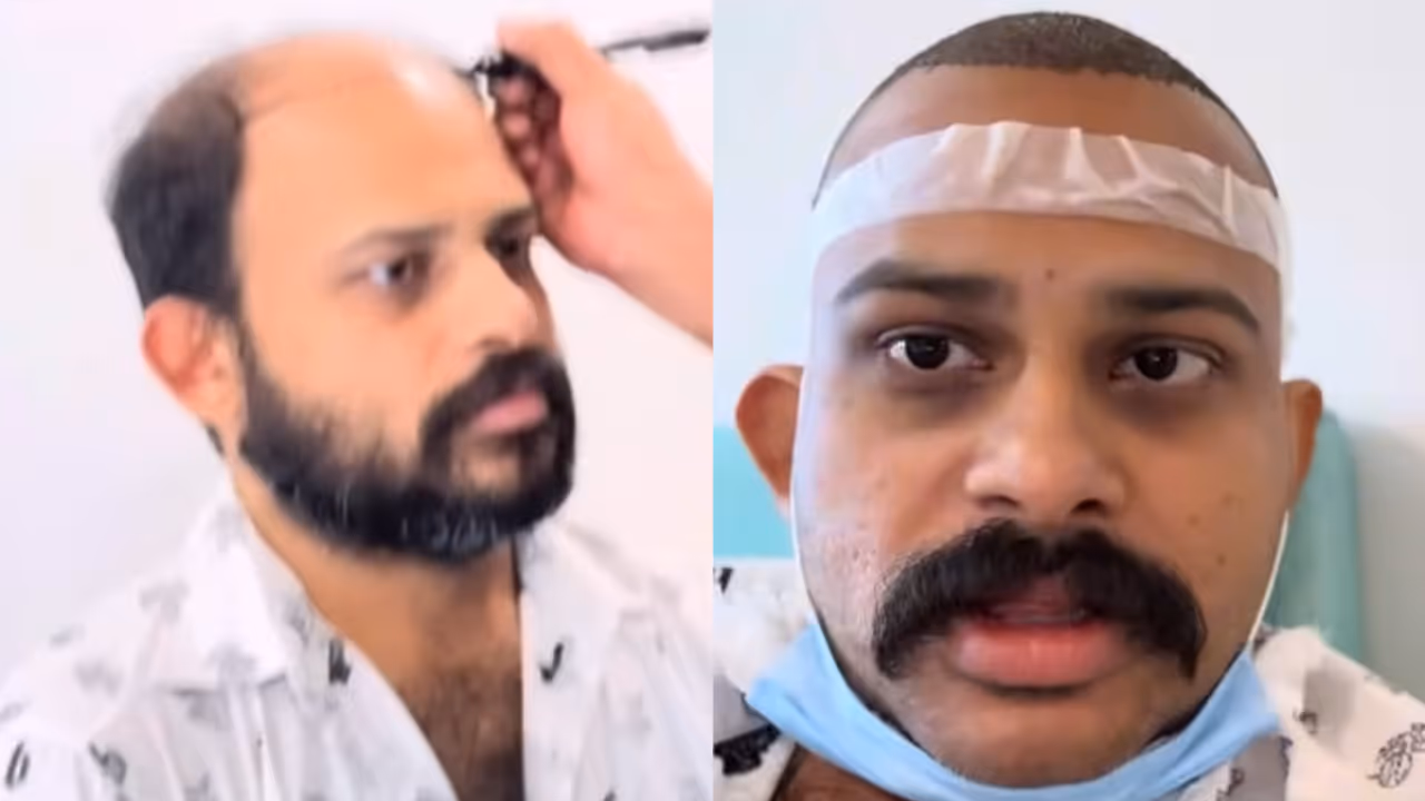 മൊട്ടത്തലയാ, കഷണ്ടി, തുടങ്ങിയ വിളികൾക്ക് അവസാനം; വീഡിയോയുമായി വിജയ് മാധവ് മൊട്ടത്തലയാ, കഷണ്ടി, തുടങ്ങിയ വിളികൾക്ക് അവസാനം; വീഡിയോയുമായി വിജയ് മാധവ്