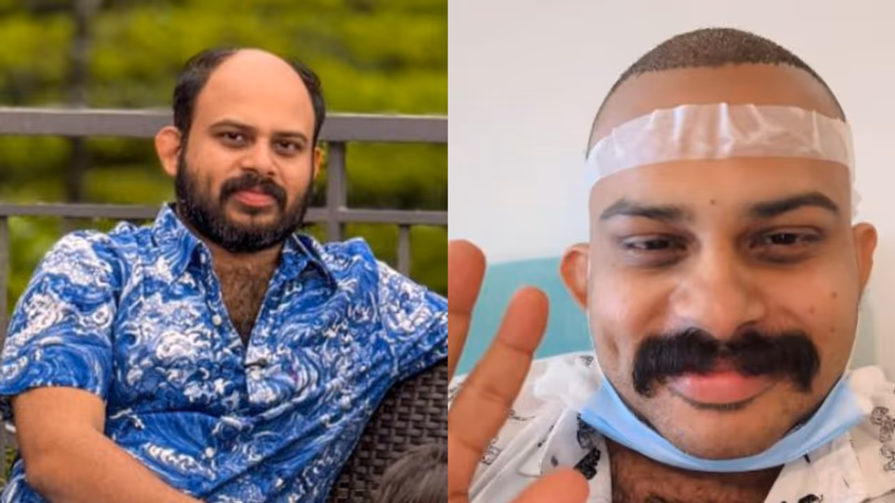 'സനിലിന് ഉണ്ടായ ദുരവസ്ഥ ആര്ക്കും വരാതിരിക്കട്ടെ'; സ്വന്തം ഹെയര് ട്രാന്സ്പ്ലാന്റ് അനുഭവം പറഞ്ഞ് വിജയ് മാധവ് 'സനിലിന് ഉണ്ടായ ദുരവസ്ഥ ആര്ക്കും വരാതിരിക്കട്ടെ'; സ്വന്തം ഹെയര് ട്രാന്സ്പ്ലാന്റ് അനുഭവം പറഞ്ഞ് വിജയ് മാധവ്