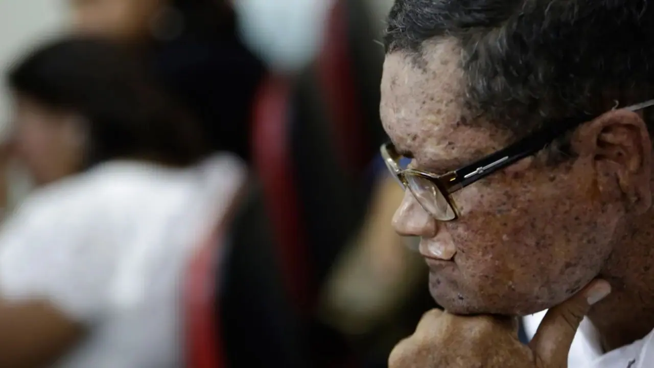 ಈ ಹಳ್ಳಿಯಯವರಿಗೆ ವಿಚಿತ್ರ ಕಾಯಿಲೆ, ಬಿಸಿಲಿಗೆ ಬಂದ್ರೆ ಚರ್ಮ ಕರಗುತ್ತೆ! ರಾತ್ರಿ ಮಾತ್ರ ಹೊರಗೆ ಹೋಗ್ತಾರೆ!