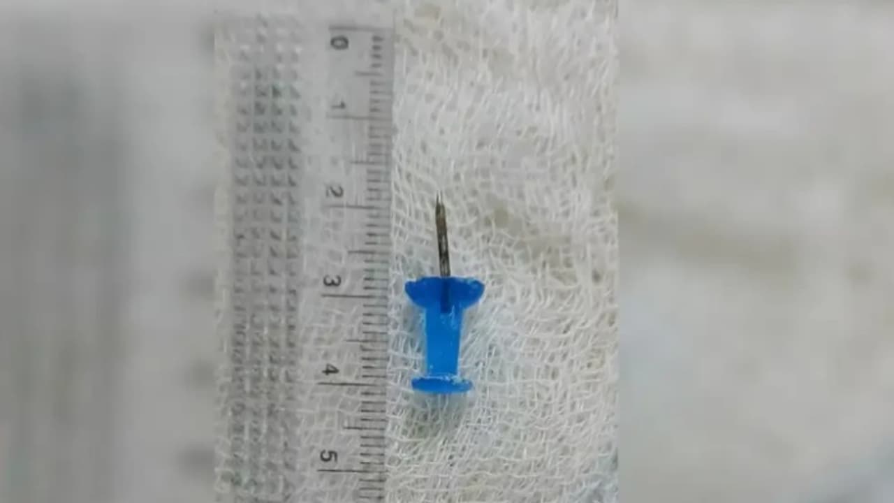 ശ്വാസംമുട്ടും നെഞ്ചുവേദനയും; 5 ദിവസം കുട്ടിയുടെ ശ്വാസകോശത്തിനകത്തിരുന്നത് ബോർഡ് പിൻ, ഗുരുതരമെന്ന് ഡോക്ടർമാർ