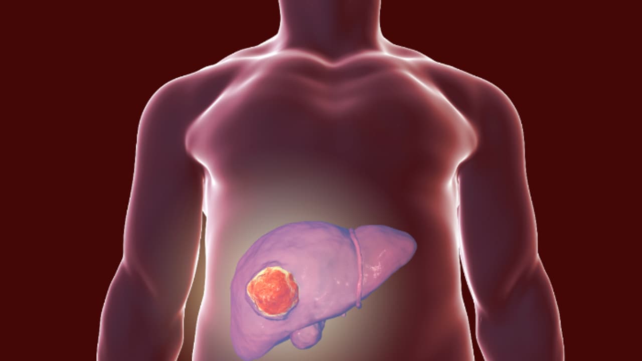 കരൾ ക്യാൻസർ സാധ്യത കുറയ്ക്കുന്നതിന് ഒഴിവാക്കേണ്ട ആറ് കാര്യങ്ങൾ