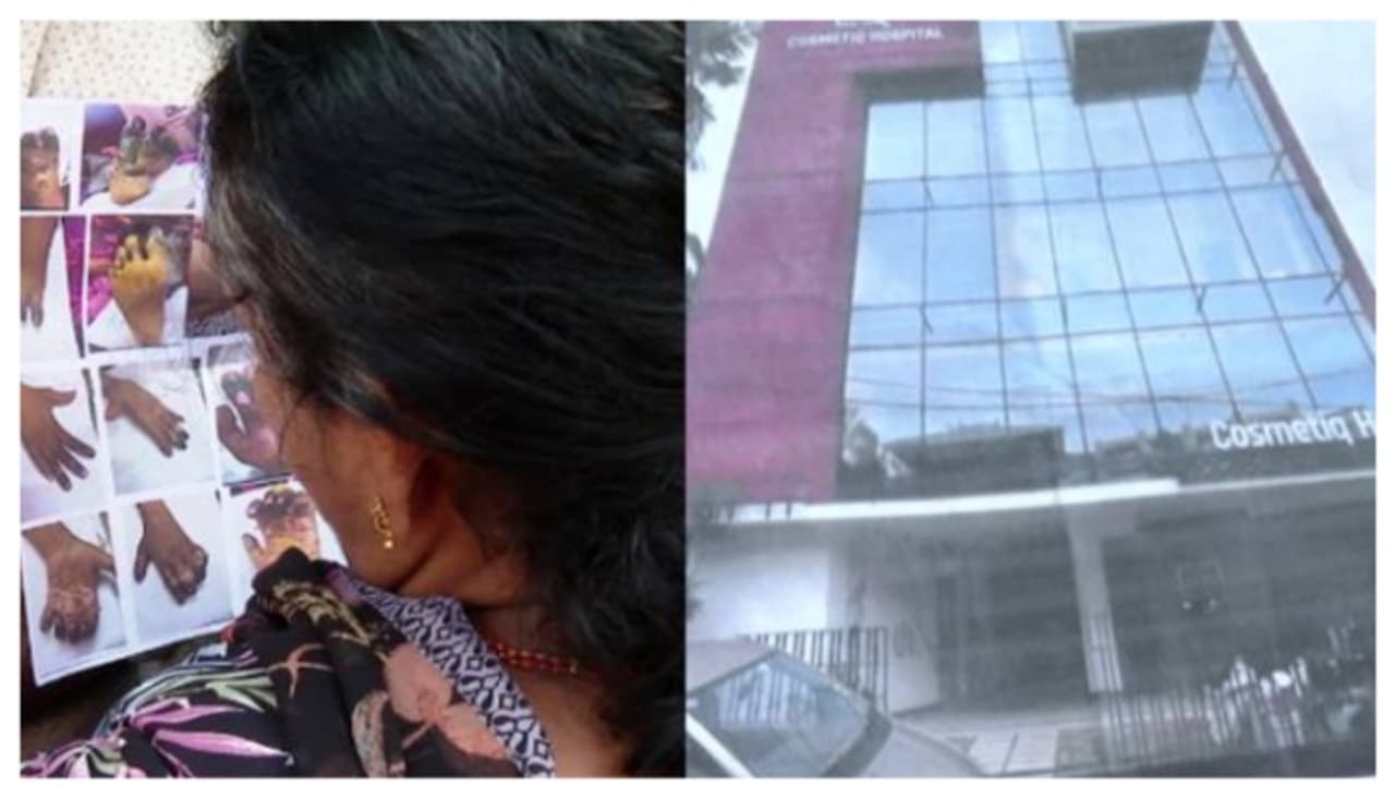 കൊഴുപ്പ് നീക്കൽ ശസ്ത്രക്രിയയിലെ പിഴവ്: ആരോഗ്യവകുപ്പിന്റെ ഉന്നത സമിതി ചികിത്സാപ്പിഴവ് പരിശോധിക്കും കൊഴുപ്പ് നീക്കൽ ശസ്ത്രക്രിയയിലെ പിഴവ്: ആരോഗ്യവകുപ്പിന്റെ ഉന്നത സമിതി ചികിത്സാപ്പിഴവ് പരിശോധിക്കും