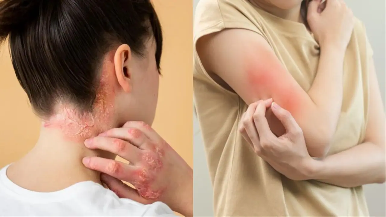 fungal infection in monsoon