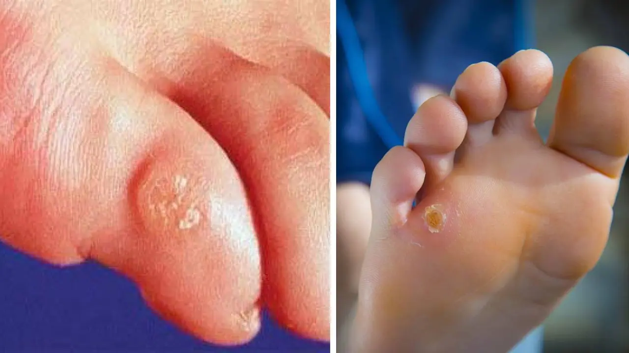 Foot Corn Home Remedies
