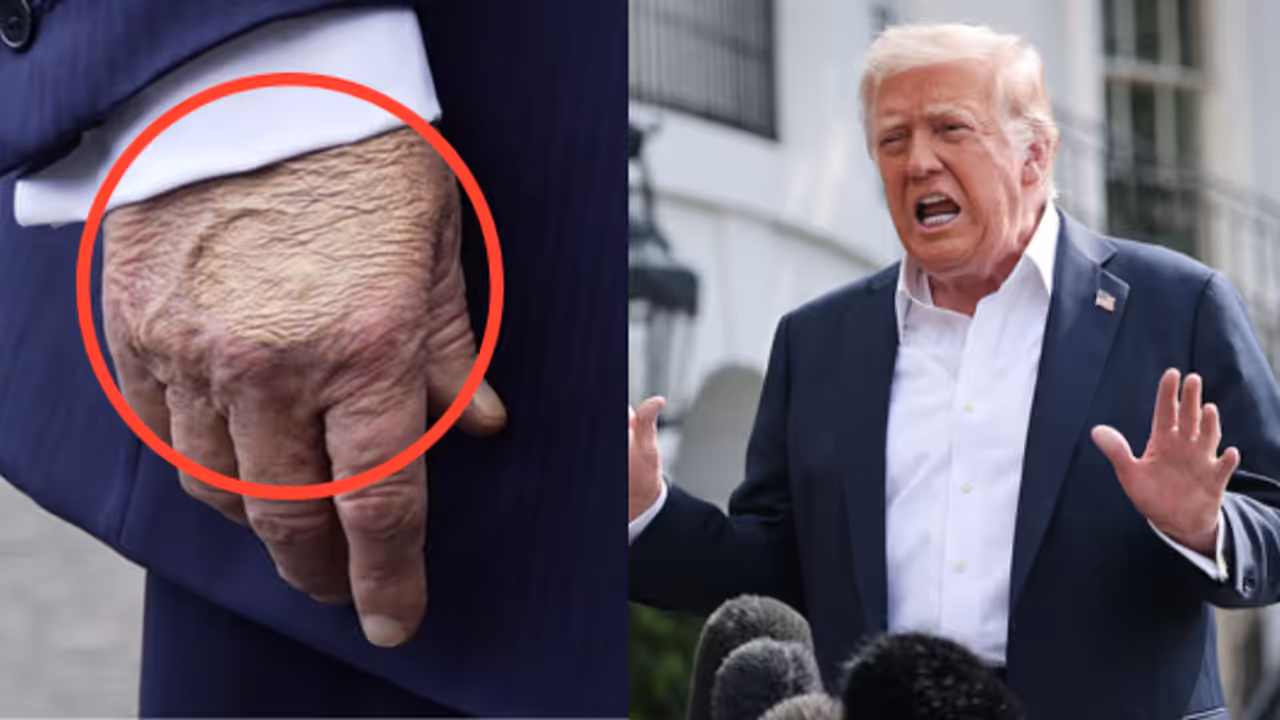  Trump Suffering from Chronic Venous Insufficiency Disease 